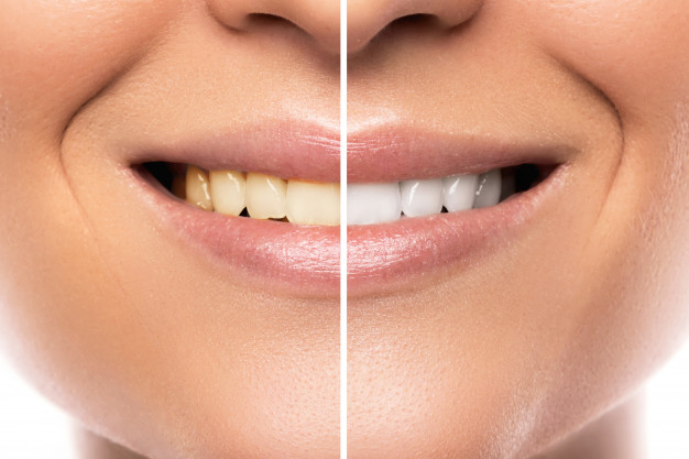 comparison after teeth (hampa) whitening